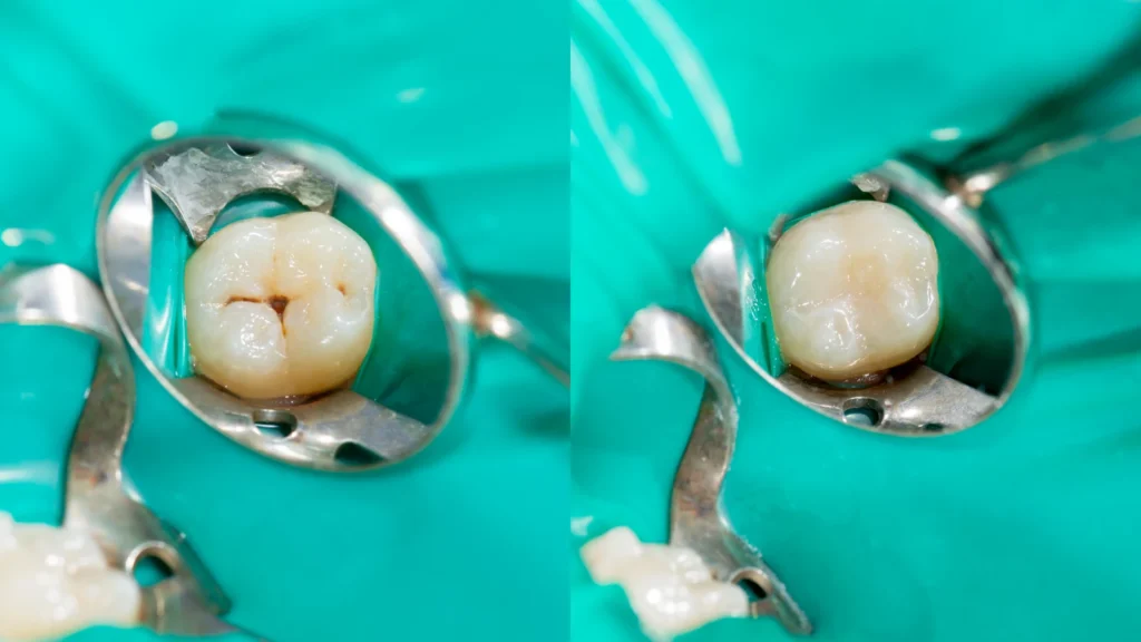 Composite bonding turkey cost : Procedure, Packages and Results