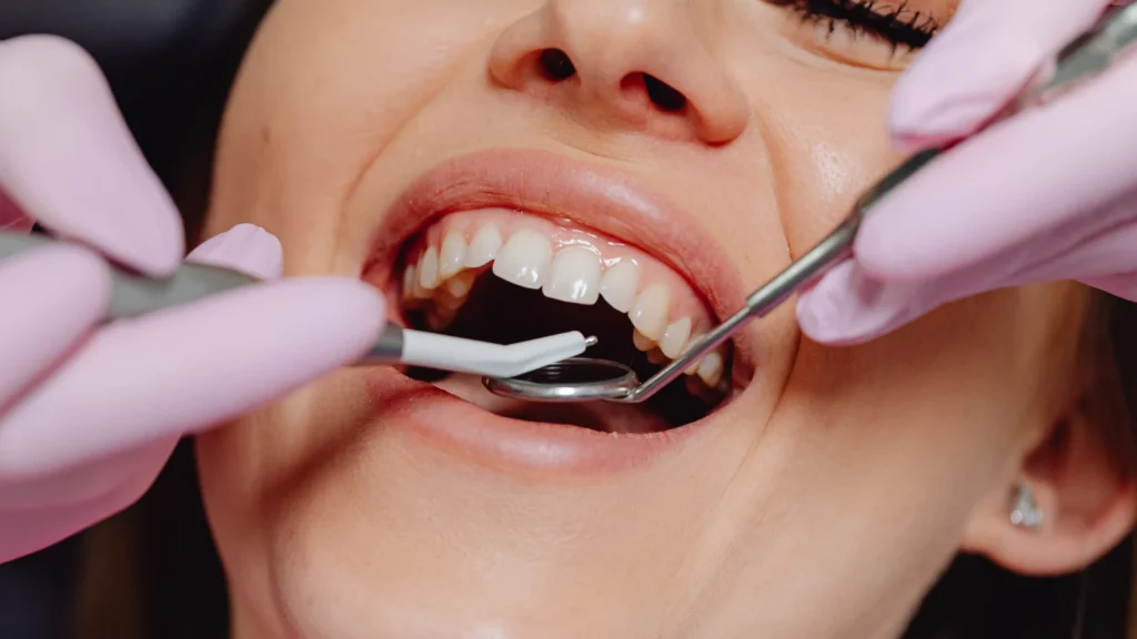 Composite bonding turkey cost : Procedure, Packages and Results