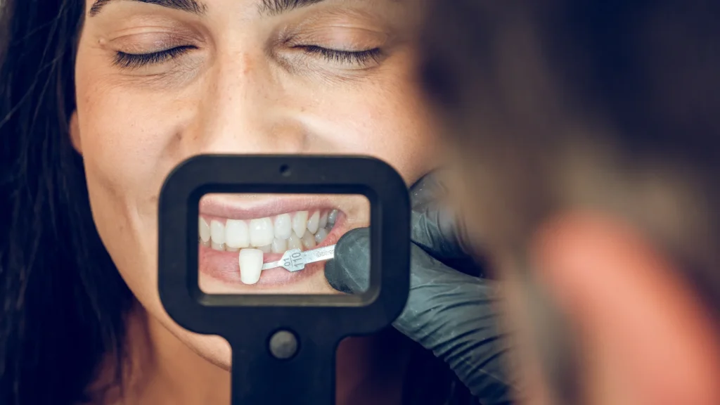 composite bonding vs veneers: Which Treatment Is Right For You?