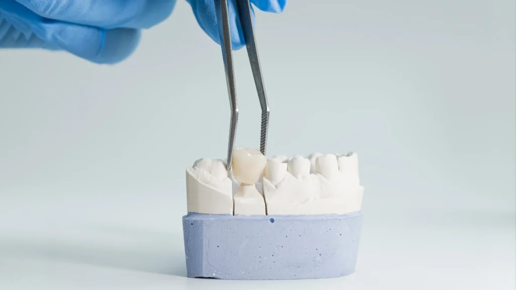 Dental Crowns Turkey: Price, Types, Lifespan, and Full-Mouth Options