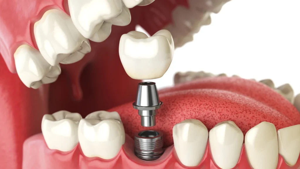 Dental Implants Turkey: Cost, Types, Packages & Safety