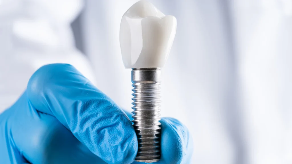 Full Mouth Dental Implants Turkey: Costs, Packages And Treatment Stages
