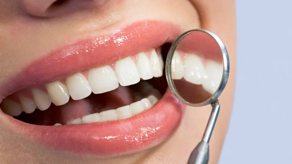 Hollywood Smile Turkey: Price, Veneers, Crowns and Procedure