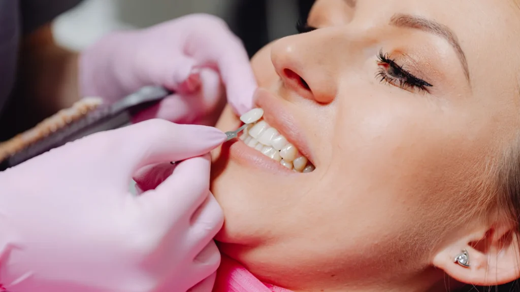 How Long Do Veneers Last? Lifespan, Replacement & Aftercare