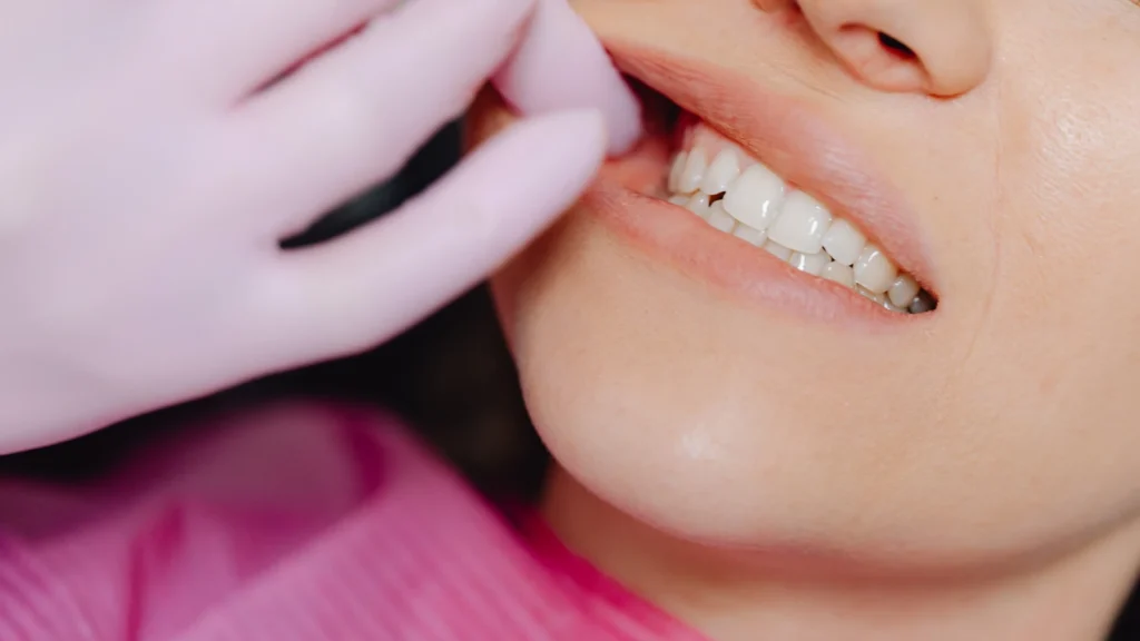 how long does composite bonding last?