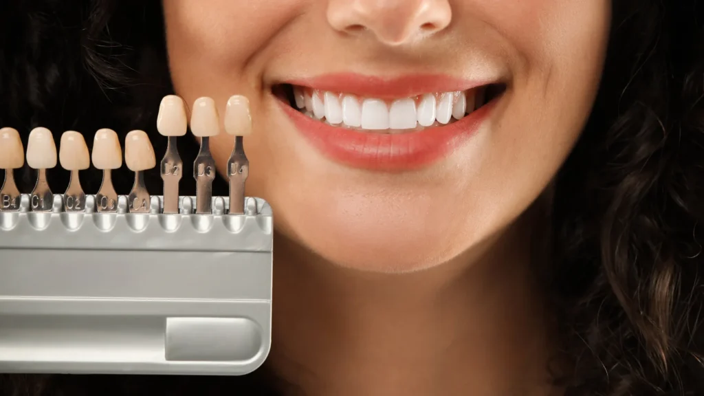 How Long Does It Take to Get Veneers? Turkey Treatment Timeline