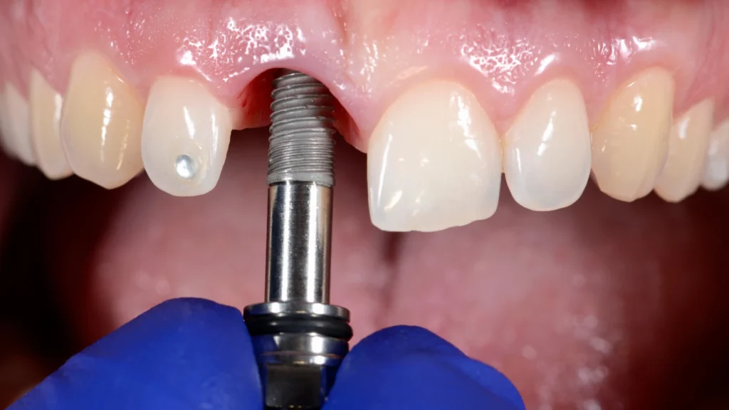 same day dental implants: Everything You Need To Know