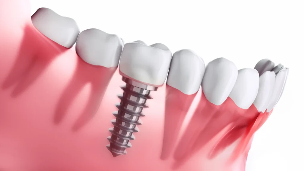 same day dental implants: Everything You Need To Know