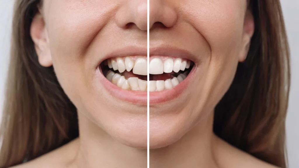 Turkey Teeth Before and After: What Should You Look For?