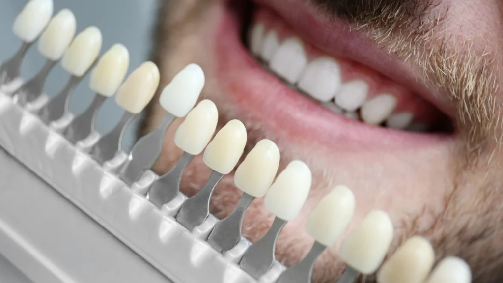 Veneers Turkey: Types, Safety, Cost and the Procedure