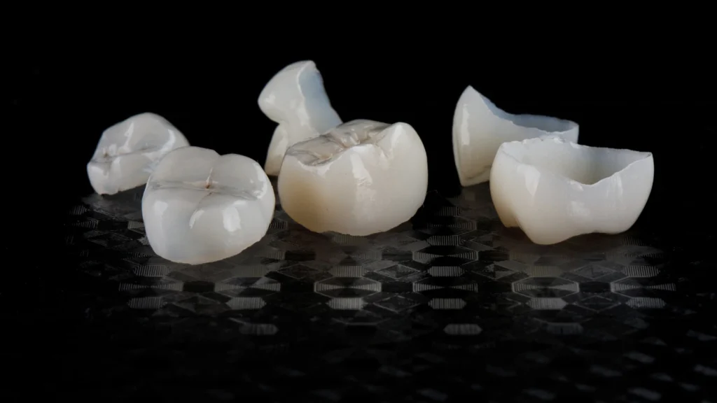 Veneers vs Crowns: Differences, Cost, Tooth Preparation & Lifespan