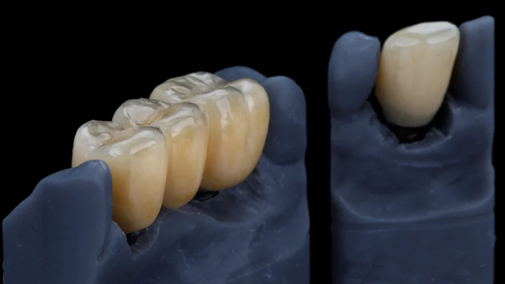 Zirconium Crowns Turkey: Cost, Benefits, Types & Procedure