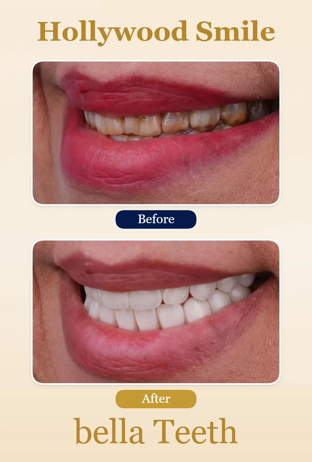 hollywood smile before and after