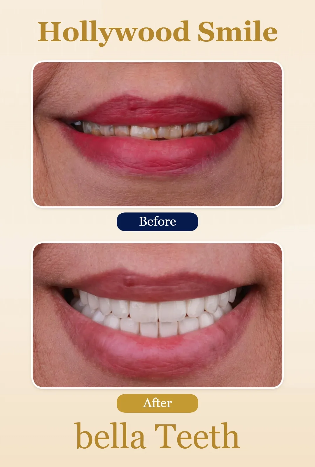 hollywood smile before and after