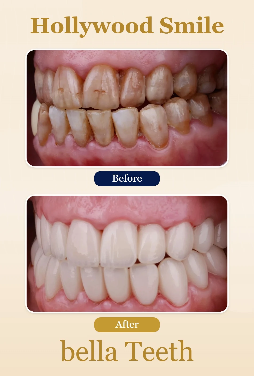 hollywood smile before and after