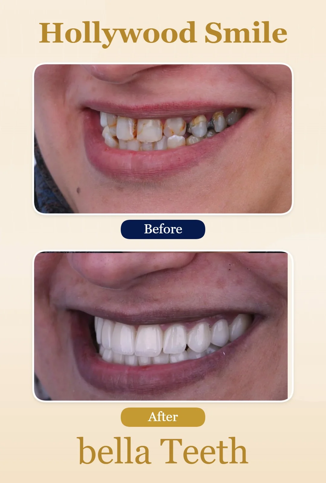hollywood smile before and after