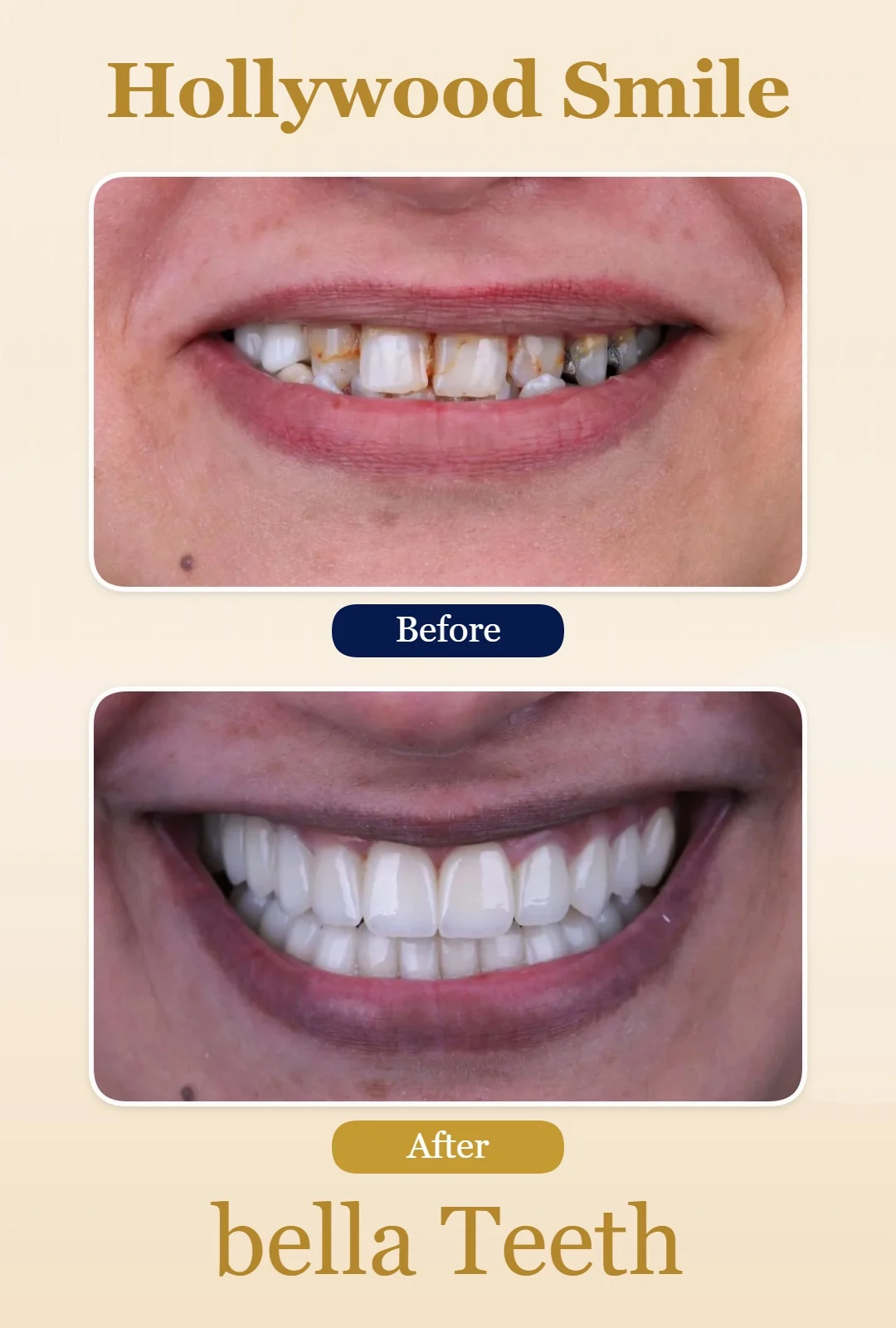 hollywood smile before and after